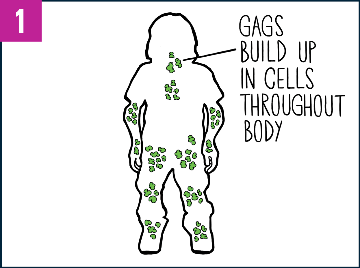 Outline of a patient's body showing GAG buildup in various areas of the body