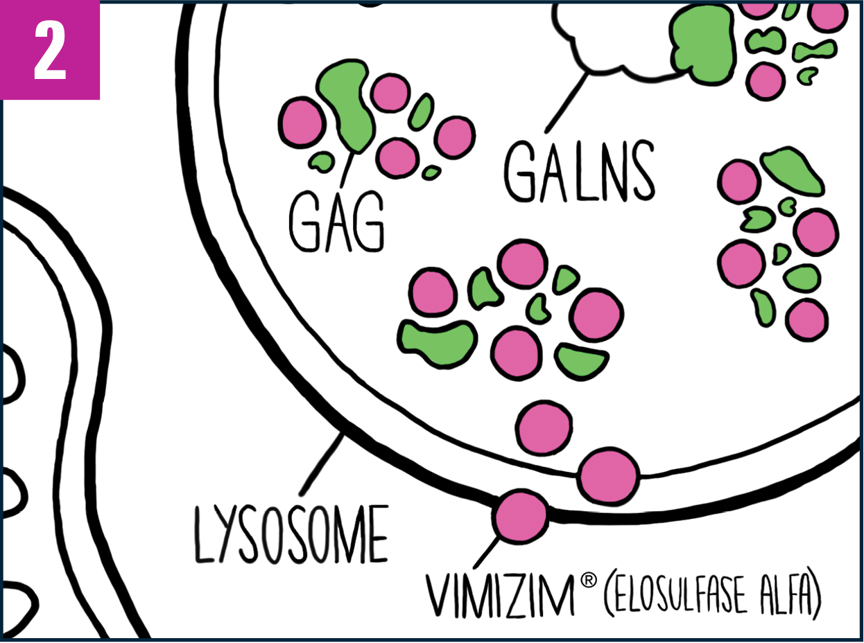 Close-up of cell showing increased GALNS enzyme in the lysosomes